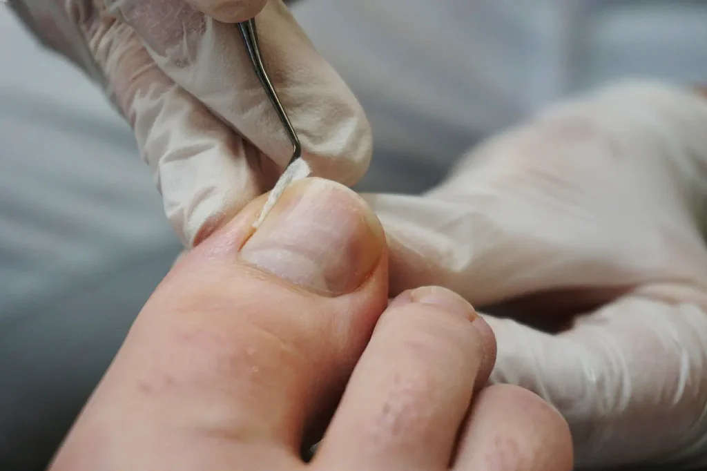 Ingrown Toenails