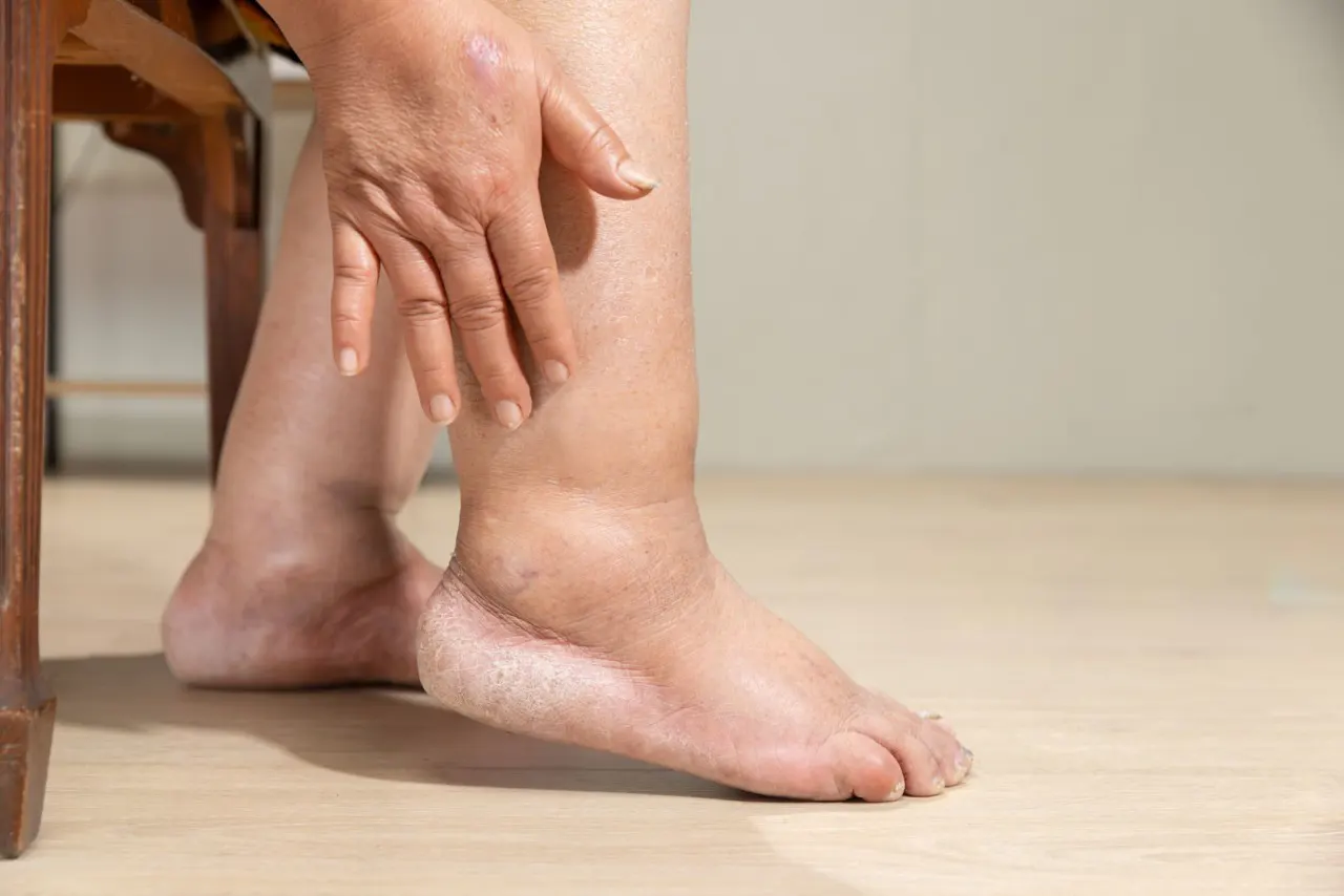 Swollen Feet (Edema) After 50 How to Protect Your Skin + Red Flags You Shouldn’t Ignore