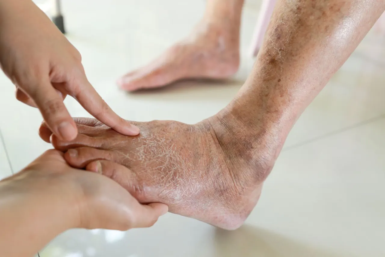 Diabetic Foot Care (Calgary) 10 Daily Habits to Prevent Ulcers