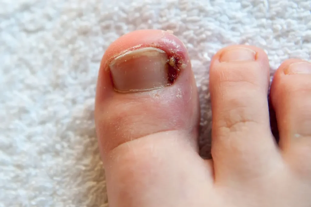 Ingrown Toenail: Early Signs, Safer Next Steps, and When to Get Help