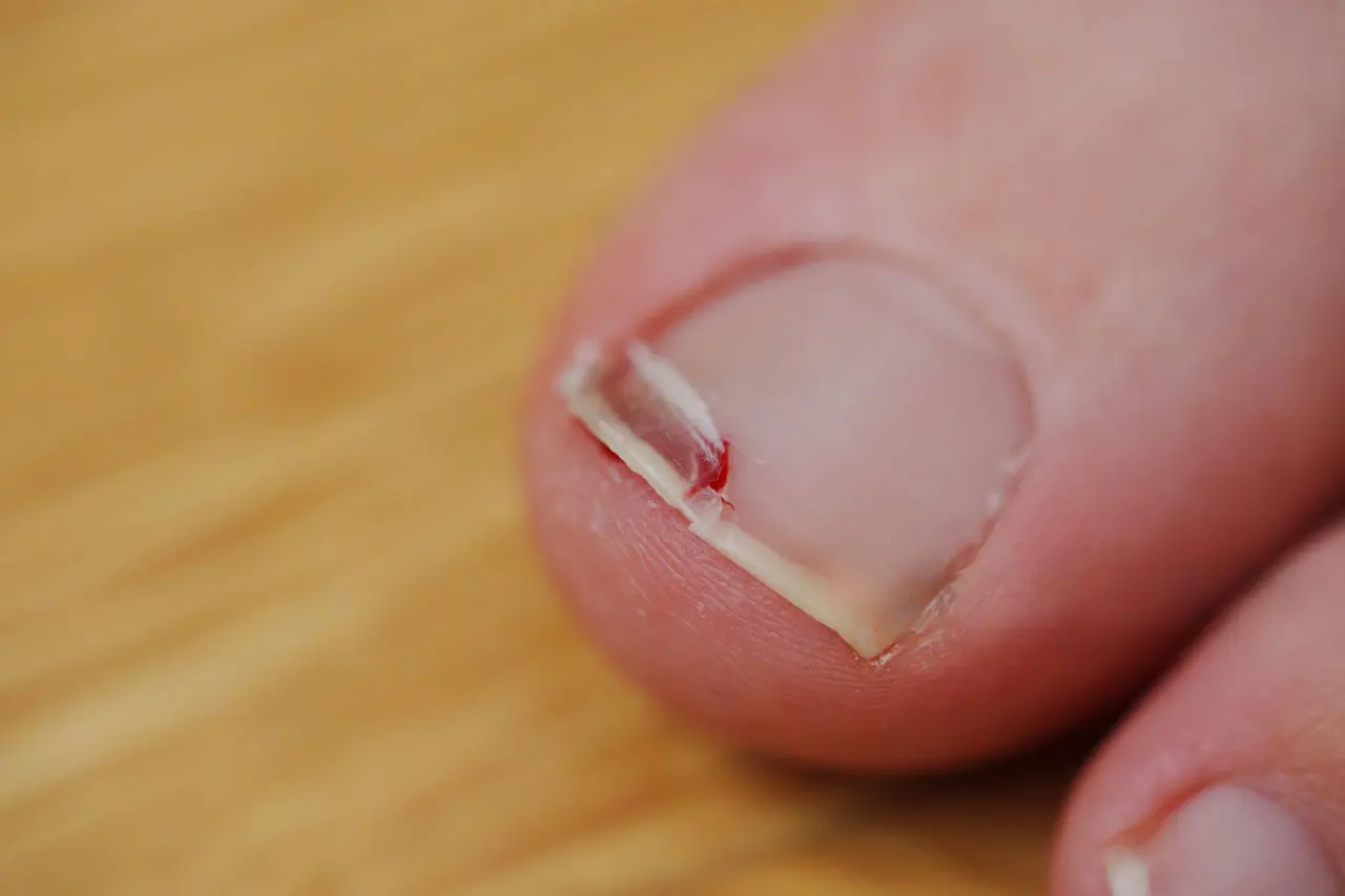 On Blood Thinners Why Nail Trimming Can Be Riskier (and Safer Options)