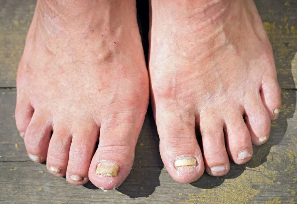 Thick Toenails After 50 Why They Happen and Safer Next Steps